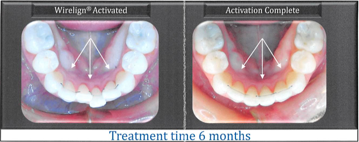 Orthodontics  Minster Dental Care