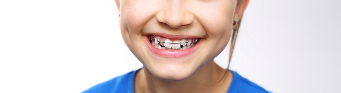 Orthodontics | Minster Dental Care