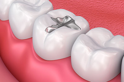 Minster Dental Care | Snoring Appliances, Dental Fillings and Intraoral Camera
