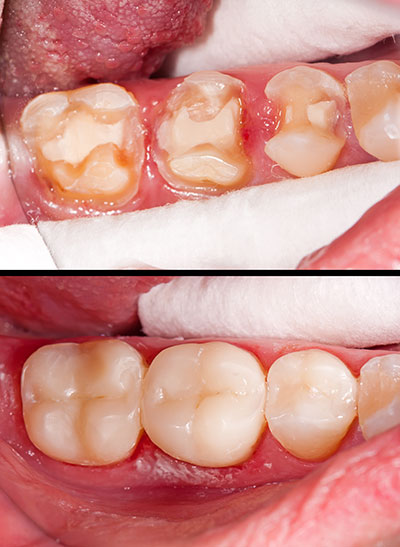 Minster Dental Care | Extractions, Sedation Dentistry and Juvederm reg 