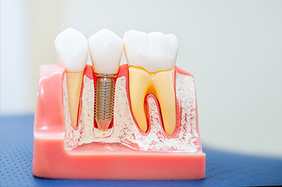 Minster Dental Care | Night Guards, Emergency Treatment and Same Day Crowns
