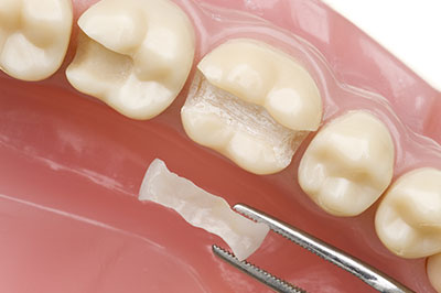 Minster Dental Care | Juvederm reg , Cosmetic Dentistry and Dentures