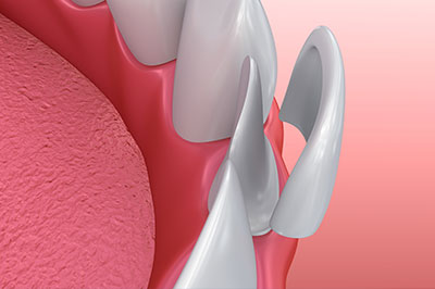 Minster Dental Care | Pediatric Extractions, Bone Grafts and Dental Cleanings
