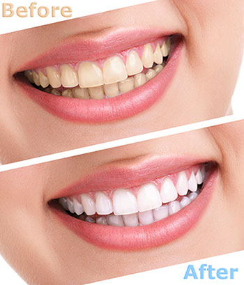 Minster Dental Care | Night Guards, Dental Bridges and SureSmile   Aligners