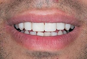 Minster Dental Care | Same Day Crowns, Oral Cancer Screening and SureSmile Aligners