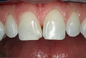 Minster Dental Care | Dental Cleanings, Ceramic Crowns and Bone Grafts